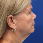 Facelift Before & After Patient #5425
