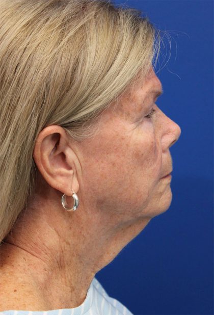 Facelift Before & After Patient #5425