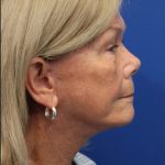Facelift Before & After Patient #5425