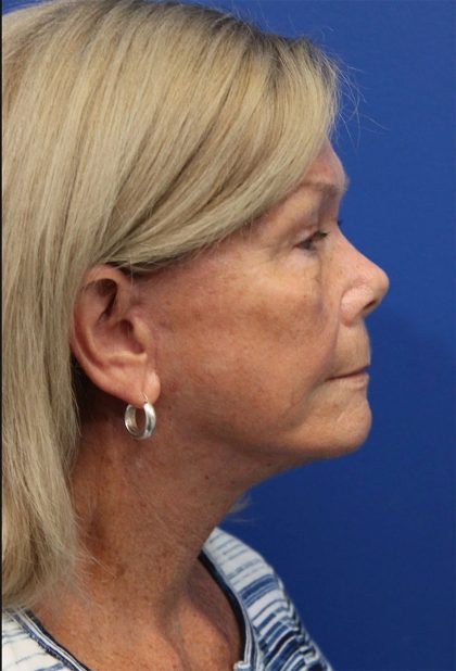 Facelift Before & After Patient #5425