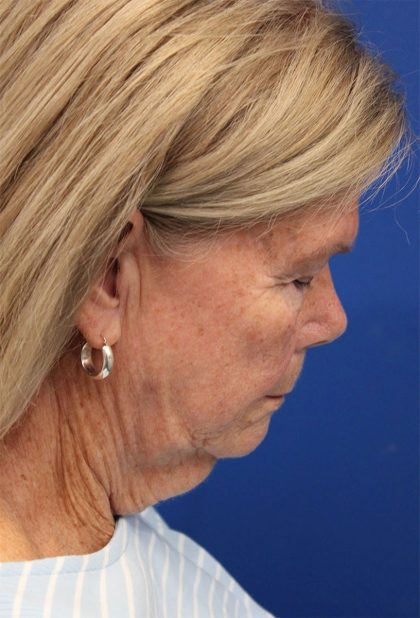 Facelift Before & After Patient #5425