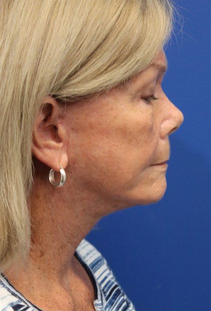 Facelift Before & After Patient #5425