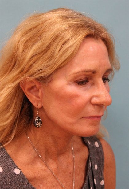 Laser Resurfacing Before & After Patient #5280