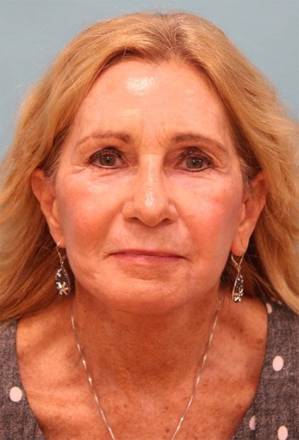 Laser Resurfacing Before & After Patient #5280