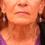 Laser Resurfacing Before & After Patient #5280