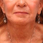 Laser Resurfacing Before & After Patient #5280