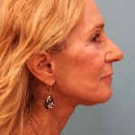 Laser Resurfacing Before & After Patient #5280