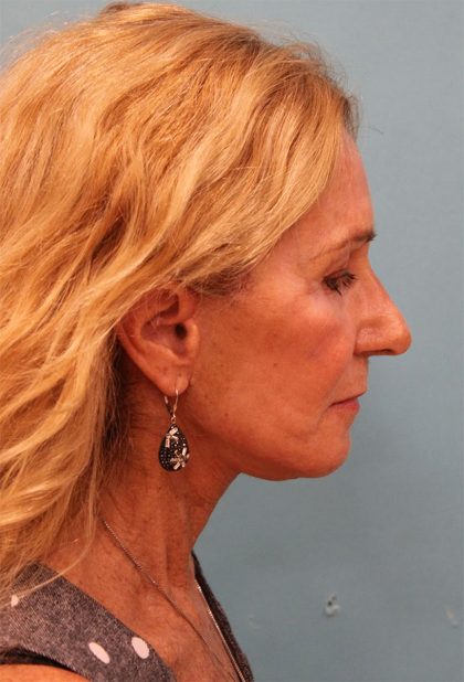 Laser Resurfacing Before & After Patient #5280
