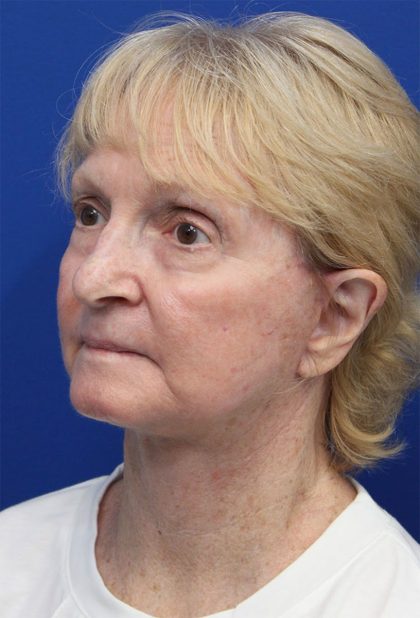 Laser Resurfacing Before & After Patient #5281