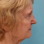 Laser Resurfacing Before & After Patient #5281