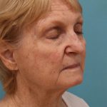 Laser Resurfacing Before & After Patient #5281