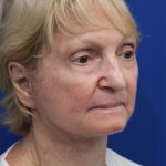Laser Resurfacing Before & After Patient #5281