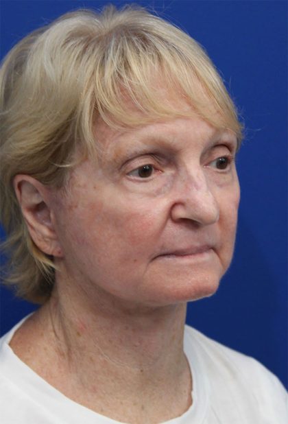 Laser Resurfacing Before & After Patient #5281