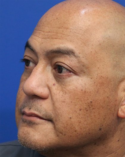Lower Blepharoplasty Before & After Patient #5282