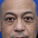 Lower Blepharoplasty Before & After Patient #5282