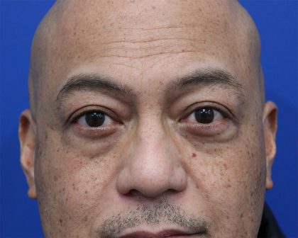 Lower Blepharoplasty Before & After Patient #5282