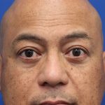 Lower Blepharoplasty Before & After Patient #5282