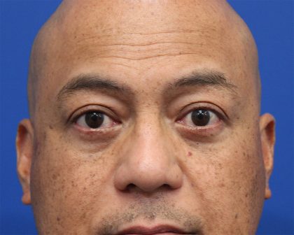 Lower Blepharoplasty Before & After Patient #5282
