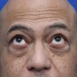 Lower Blepharoplasty Before & After Patient #5282