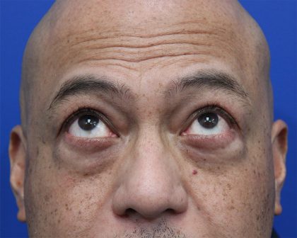 Lower Blepharoplasty Before & After Patient #5282