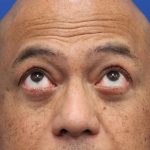Lower Blepharoplasty Before & After Patient #5282