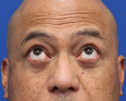 Lower Blepharoplasty Before & After Patient #5282