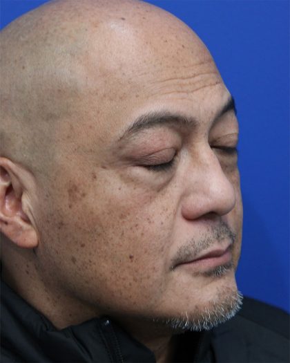Lower Blepharoplasty Before & After Patient #5282