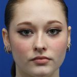 Rhinoplasty Before & After Patient #5286
