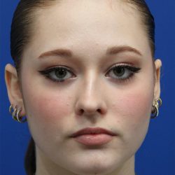 Rhinoplasty Before & After Patient #5286