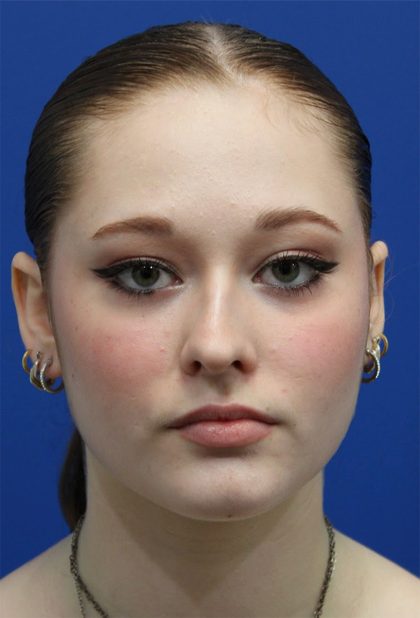 Rhinoplasty Before & After Patient #5286