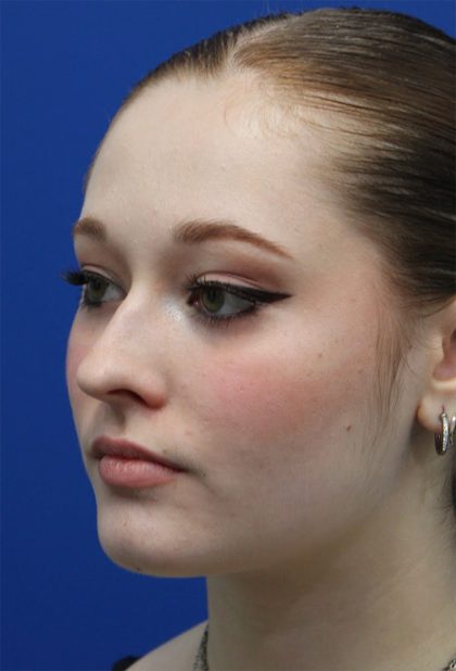 Rhinoplasty Before & After Patient #5286