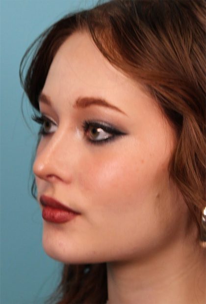 Rhinoplasty Before & After Patient #5286