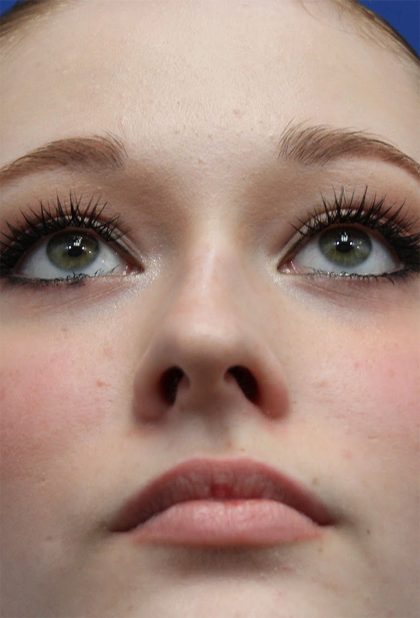 Rhinoplasty Before & After Patient #5286