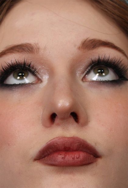 Rhinoplasty Before & After Patient #5286