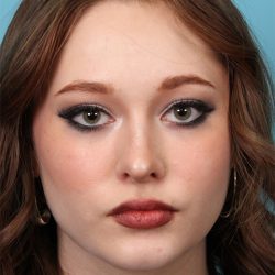 Rhinoplasty Before & After Patient #5286