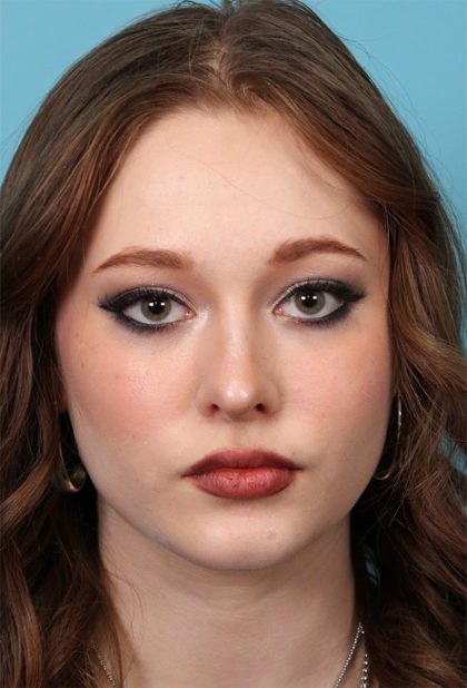 Rhinoplasty Before & After Patient #5286