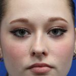 Rhinoplasty Before & After Patient #5286
