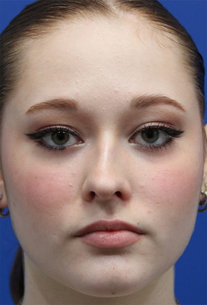 Rhinoplasty Before & After Patient #5286