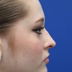 Rhinoplasty Before & After Patient #5286