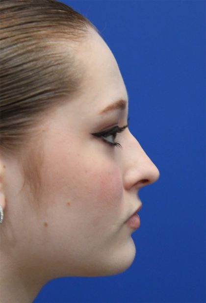 Rhinoplasty Before & After Patient #5286