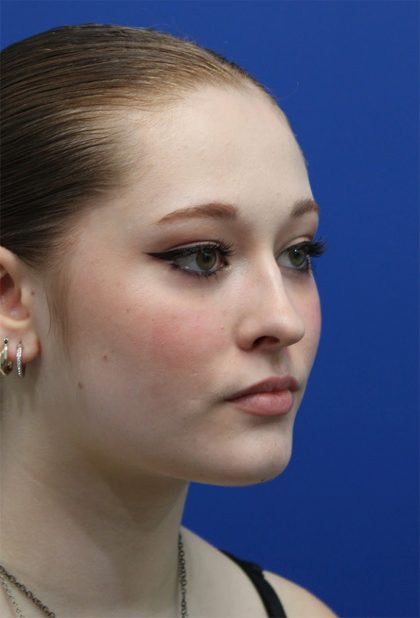Rhinoplasty Before & After Patient #5286