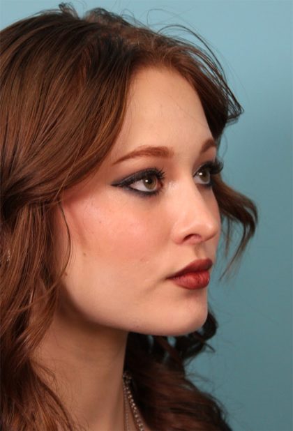 Rhinoplasty Before & After Patient #5286