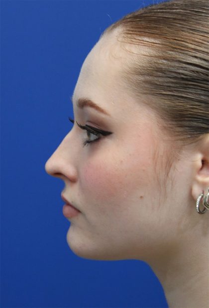 Rhinoplasty Before & After Patient #5286