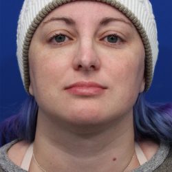 Submental Liposuction Before & After Patient #5284