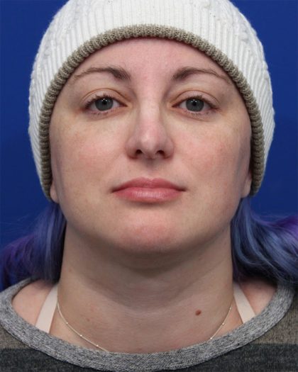 Submental Liposuction Before & After Patient #5284