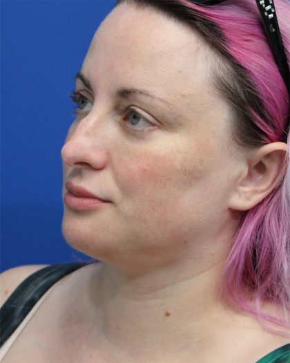 Submental Liposuction Before & After Patient #5284