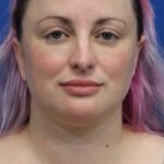 Submental Liposuction Before & After Patient #5284