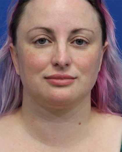 Submental Liposuction Before & After Patient #5284