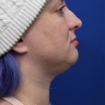 Submental Liposuction Before & After Patient #5284