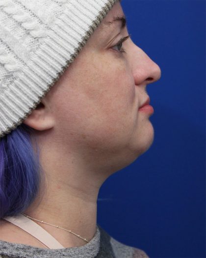 Submental Liposuction Before & After Patient #5284